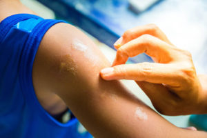 applying anti-itch cream to an insect bite